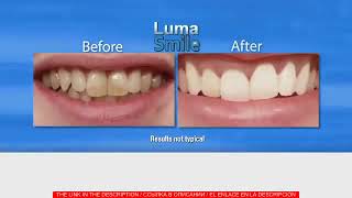 Luma Smile Diş Beyazlatma Seti