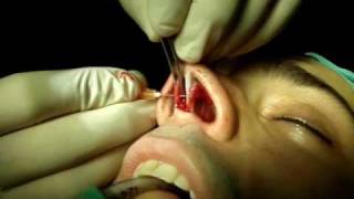 Cirugía nasal (Rinoplastia) para tratamiento de la punta.