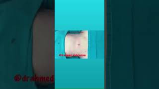 Liposuction body contouring ..شفط الدهون ونحت الجسم