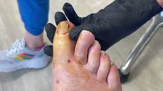 Watch Here: Ingrown Toenail Removal