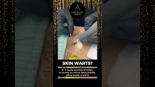 Are you dealing with skin warts? #shorts