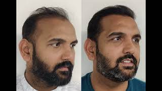 Hair transplant in Mumbai | Best Results & Cost of Hair Transplant in Mumbai