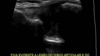 Ultrassom do Ombro - Luxação Acromioclavicular - LAC II