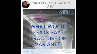 WHAT WOULD KEATS SAY: SCAPULA NORMAL VARIANT RADIOLOGY X-RAY SHOULDER