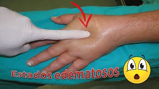 Estados edematosos - Parte 2 de 2