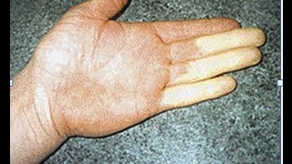 How to Prevent Vibration White Finger in the Workplace