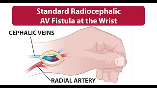 Dialysis k liye fistula !