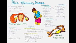 Pelvic Inflammatory Disease