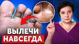 Как избавиться от грибка на ногах? Лучшее лечение грибка на стопах и пальцах