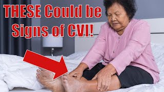 Subtle Signs Of Chronic Venous Insufficiency!