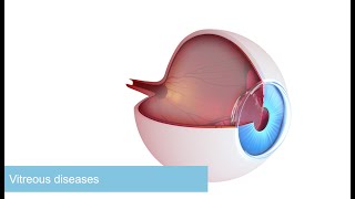 Vitreous body diseases: Causes, symptoms, diagnosis & treatment. Essentials in 3 minutes.