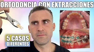 ORTODONCIA con EXTRACCIONES 🔩 5 ANTES y DESPUÉS | Tratamiento de mordidas CLASE 1, 2 y 3