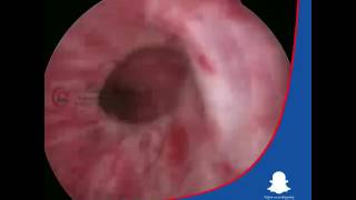 Ureteroscopy - Transurethral Resection of the Prostate (TURP) Dr. Ali Mehdi Zadeh Urologist