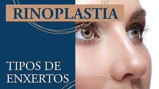 Rinoplastia Estruturada: Tipos de Enxertos - Dr. Fábio Maniglia