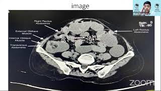 PG Masterclass- Case on Incisional Hernia by Dr. Girish