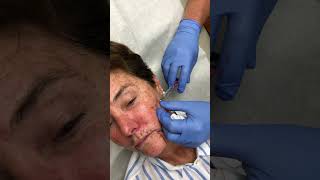 Botox and Fillers Full Face Transformation | Dr. Michael Kelly | Miami Plastic Surgery