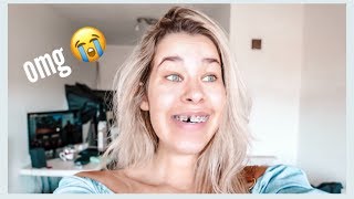 O QUE ACONTECEU COM MEU DENTE? ~vlog~