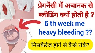 Reasons For Bleeding In Pregnancy | Subchorionic hemorrhage | Early Miscarriage | Early Pregnancy