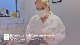 Resultados del estudio de radiofrecuencia facial | Dermaforyou by Dra Carmen Galera