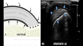 Rotator Cuff Tears diagnosis on Ultrasound