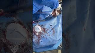 Endometriotic Ovarian Cyst Sclerotherapy