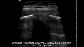 ULTRASSOM DO JOELHO - LESÃO DO LIGAMENTO COLATERAL MEDIAL.