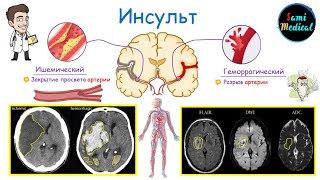 Инсульт Головного Мозга | Виды | Анатомия | Физиология | Патогенез | Клиника | Диагностика | Лечение