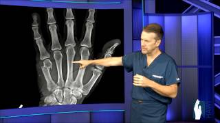 Hand Fracture Surgery