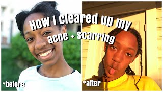 How I cleared up my acne + scarring