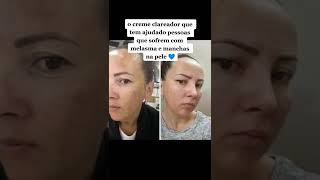 Melasma ou Manchas na pele ? Assista esse vídeo! #melasma #skincare #pele #manchasnapele #dicas