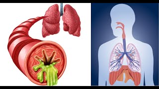 How to Remove Mucus From Lungs Naturally?