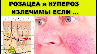 РОЗАЦЕА и КУПЕРОЗ ИЗЛЕЧИМЫ ЕСЛИ