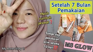 SETELAH 7 BULAN PAKAI MS GLOW ACNE SERIES + LIFTING SERUM + DTE | My Acne Story 2