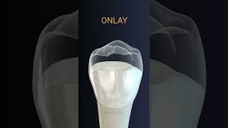 Onlay dental crown