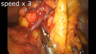 LAPAROSCOPİC SUBTOTAL GASTRECTOMY - GASTROJEJUNOSTOMY FOR GASTRİC CANSER-All Stapler Murat Akbaba MD