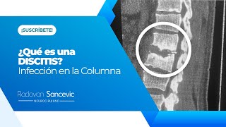 ¿Qué es una DISCITIS? INFECCIÓN EN LA COLUMNA VERTEBRAL - Dr. Radovan Sancevic