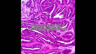 Histopathology of Hidradenoma Papilliferum #shorts #dermpath #dermatopathology