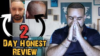 Day 2- After Hairtransplant Honest Review