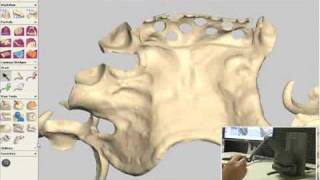 Removable Partial Dentures Complete