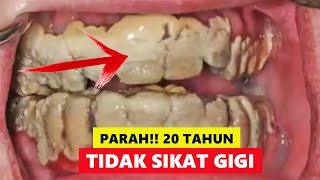 20 TAHUN TIDAK SIKAT GIGI, KARANG GIGINYA PARAH | TARTAR TEETH REMOVAL Video Reaction