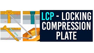 Locking compression plate (LCP)