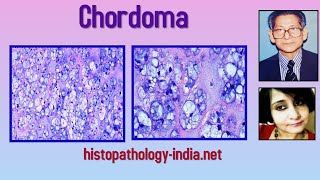 Pathology of Chordoma by Dr Sampurna Roy MD