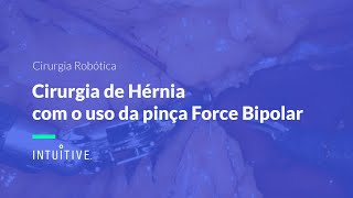 Cirurgia de Hérnia com o uso da pinça Force Bipolar