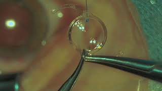 Tecnis Symfony IOL - scleral fixation technique by Prof. D. Zhaboedov