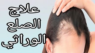 العلاج الوحيد للصلع الوراثي وتساقط الشعر الشديد  وحقيقة المينوكسيديل _ all about minoxidil