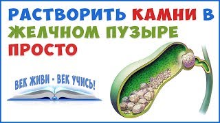 Как растворить Камни в Желчном Пузыре и Печени без операции!