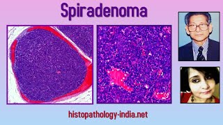 Pathology of Spiradenoma by Dr Sampurna Roy MD (dermpath, dermatopathology)