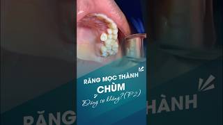 Răng mọc thành chùm có đáng sợ không (P2) #dental #nhakhoa