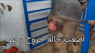 أسوء و أصعب حالة خروج رحم