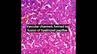 Histopathology of Intravascular Papillary Endothelial Hyperplasia (Masson Tumour)  #dermpath